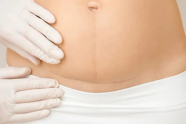 Kiedy do fizjoterapeuty po cc, aby uniknąć bólu i komplikacji?